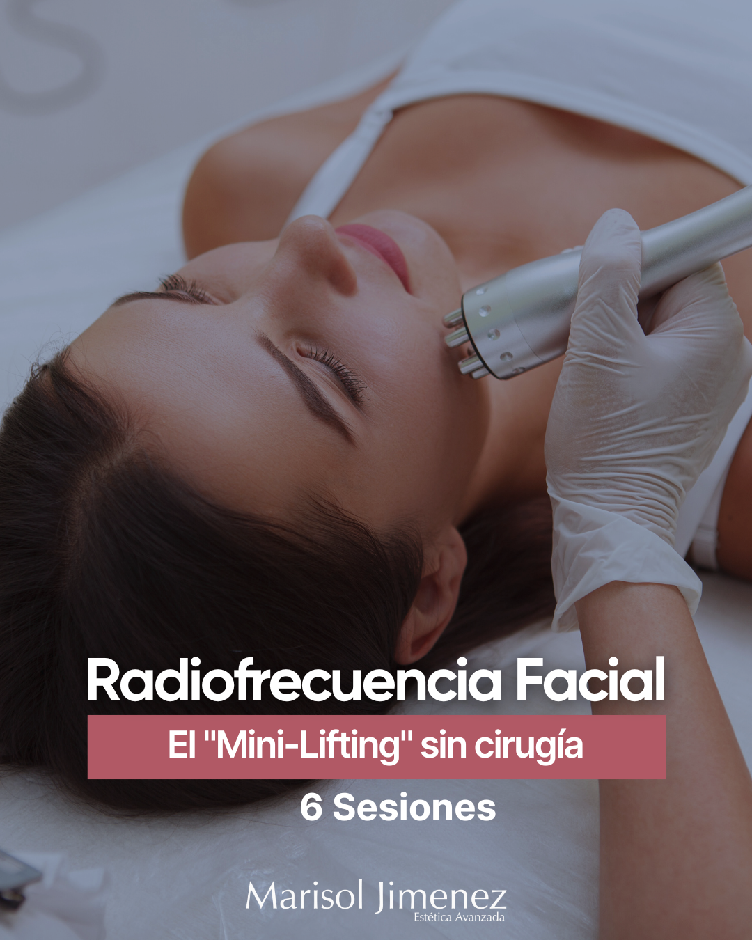 Radiofrecuencia Facial - 6 Sesiones